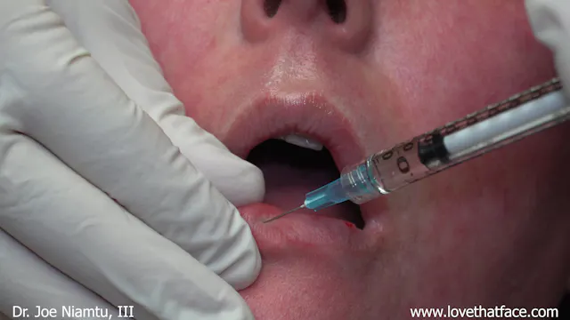 Silicone to Upper and Lower Lips