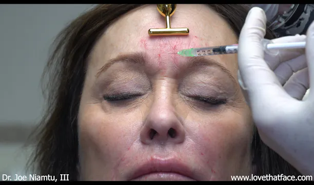 Botox over Filler in Glabella
