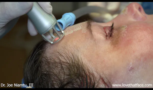 Fractional Laser to Face and Facelift Flap