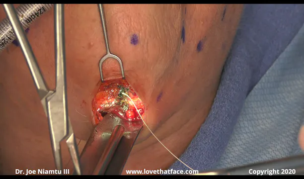 Close Up Great Platysmaplasty Case 2