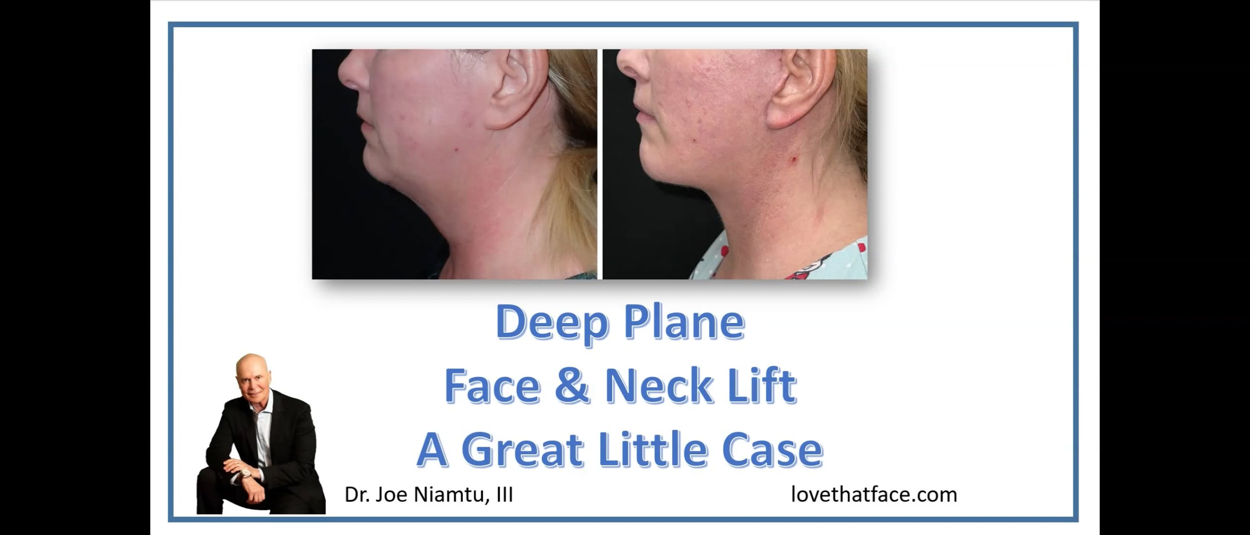Great Little Deep Plane Facelift Case