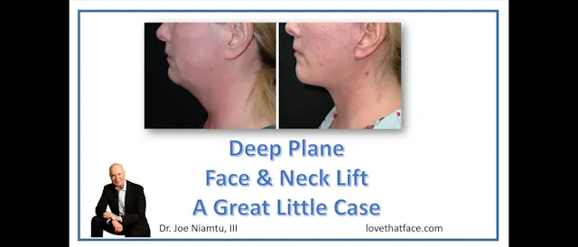 Great Little Deep Plane Facelift Case