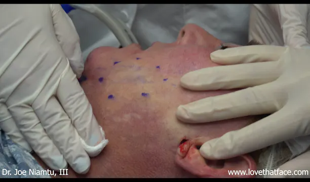 Jowl Liposuction Case 1