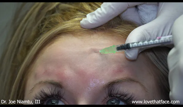 Botox to Glabella and Frontalis in Young Patient 1D