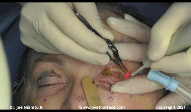 Endoscopic Brow and Forehead Lift Case 2
