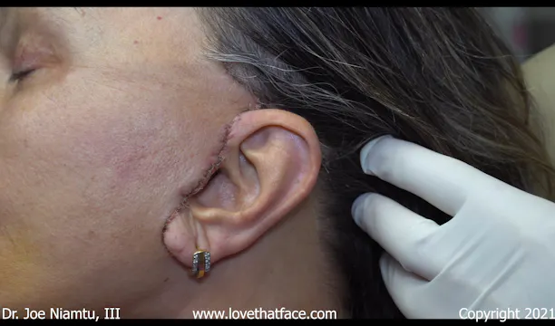 Revision Facelift part 3