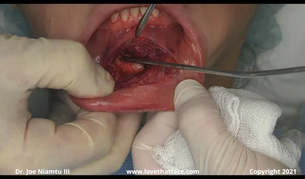 Chin Implant Removal of 20 Year Old Silicone Implant