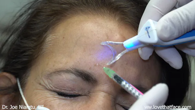 Botox 20 Units split between glabella and frontalis