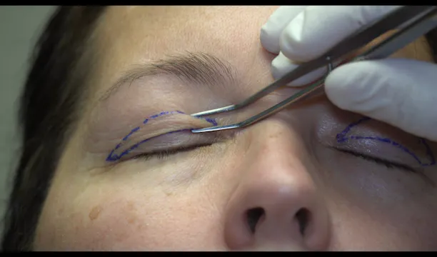 Blepharoplasty Marking Case 1