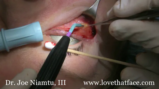 Subciliary Approach to Lower Lid Blepharoplasty