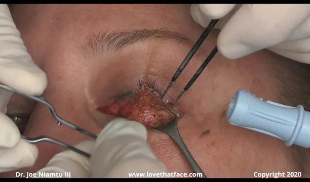 Lower Transconjunctival Laser Blepharoplasty and CO2 Laser to lower Lids