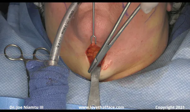 Close Up Great Platysmaplasty Case 1