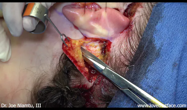 Facelift Incision and Flap Development