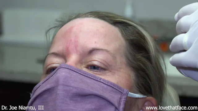 Restylane Injection to glabella