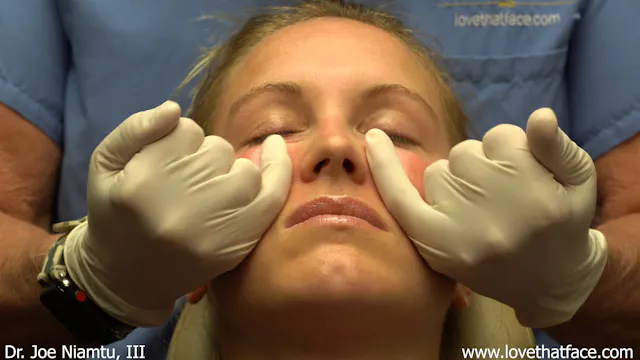 Restylane Lyft to Cheeks
