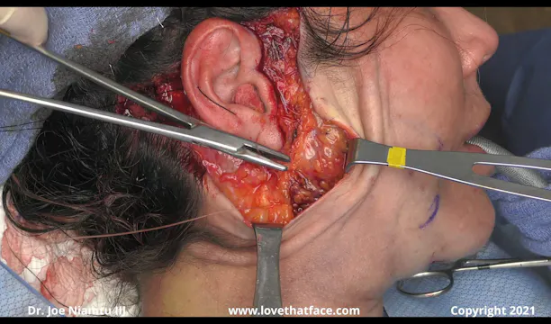 Case 2  Part 2. Unilateral FL with CO2 Part 2