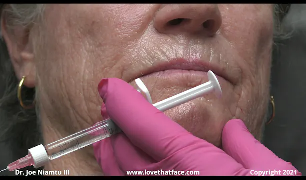 Restylane to Lip Lines