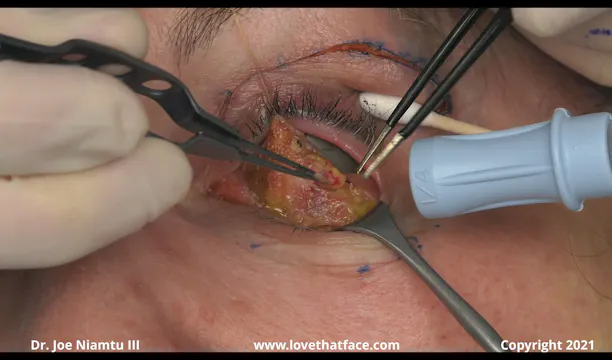 Unilateral Upper and Lower Laser Blepharoplasty