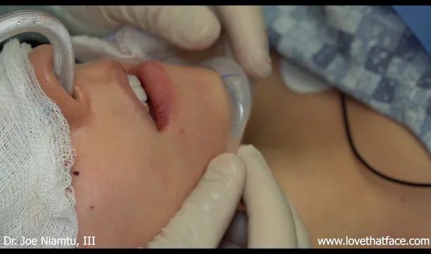 Intraoral Removal and Replacement of Silicone Chin Implant-Surgeon's View