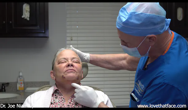 One Week After Facelift Follow Up