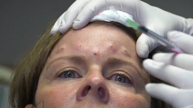 25 units of Botox to the glabella
