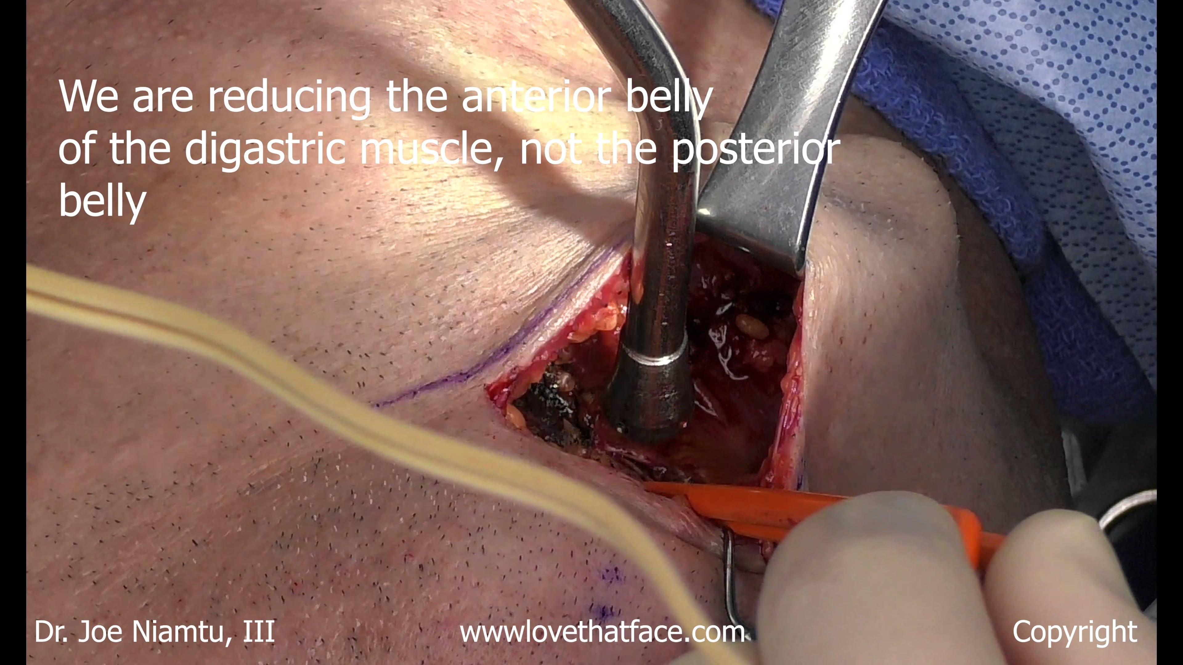 2.  Deep Plane Neck Without Submandibular Gland  Reduction