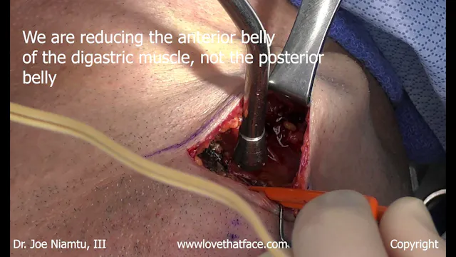 2.  Deep Plane Neck Without Submandibular Gland  Reduction