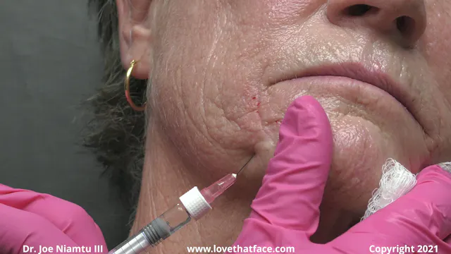 Restylane to Perioral Wrinkles