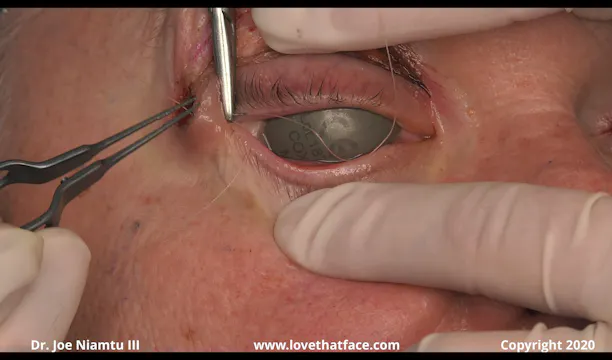 Canthopexy, Suturing Upper Bleph, Laser to Lower Lids