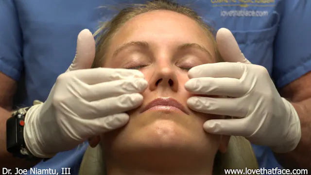 Restylane Lyft to Cheeks