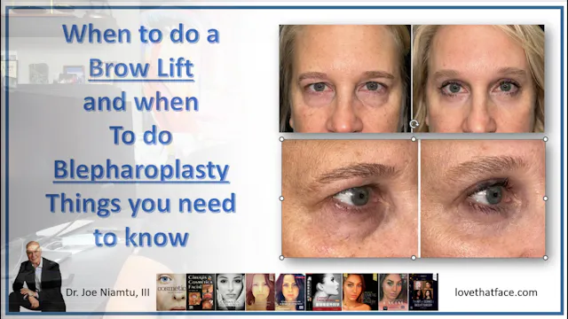 Blepharoplasty Versus Brow
