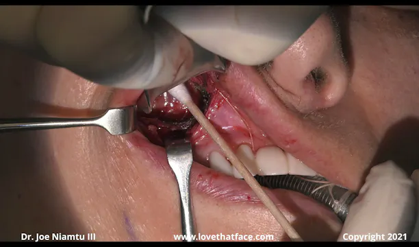 Submalar Cheek Implant Placement Case 1A