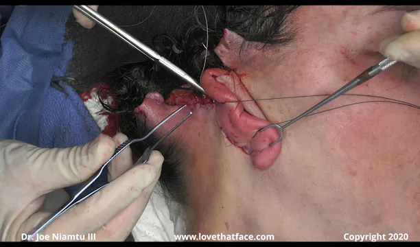 Great Posterior Key Sutures and Skin Excision