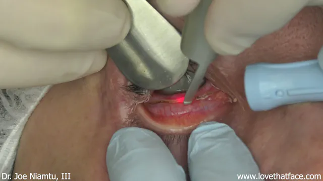 Lower Revision Blepharoplasty and Fractional CO2 Laser Skin Resurfacing