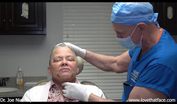 One Week After Facelift Follow Up