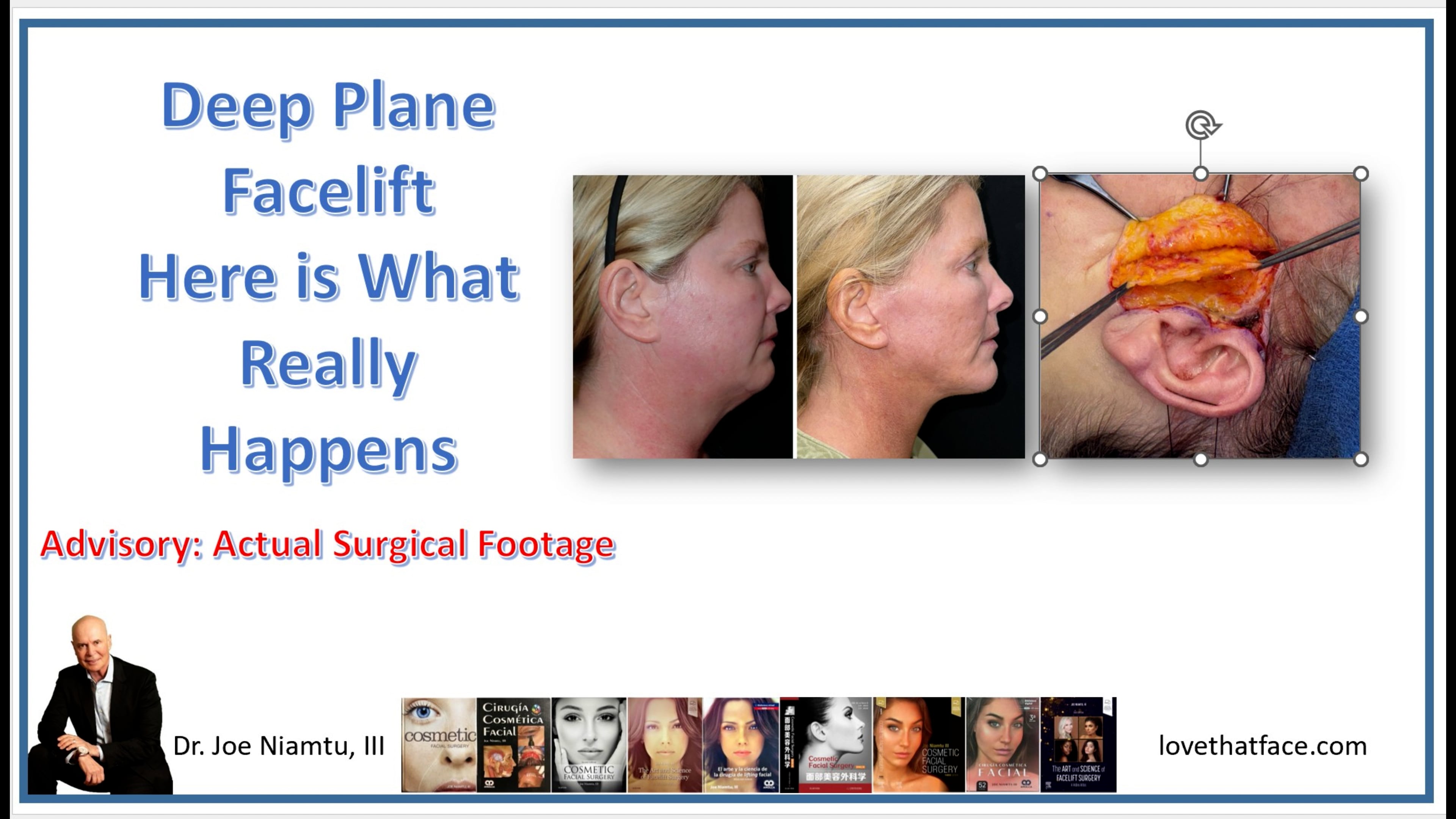 Deep Plane Facelift What Really Happens final