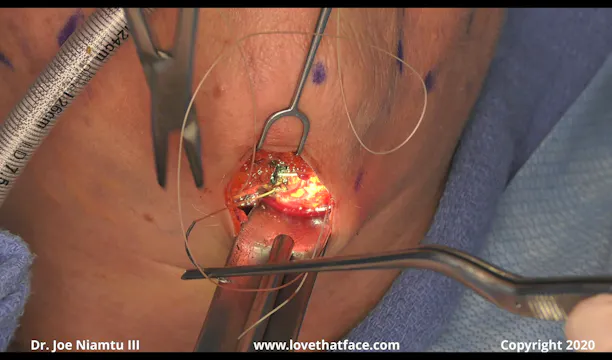 Close Up Great Platysmaplasty Case 2
