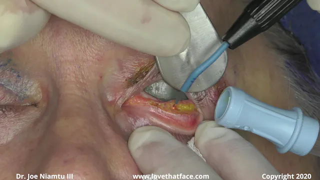 Upper Lid Laser Blepharoplasty, Lower Lid Transconjunctival Blepharoplasty with Radiowave Incision, Canthopexy and CO2 Lower Lid
