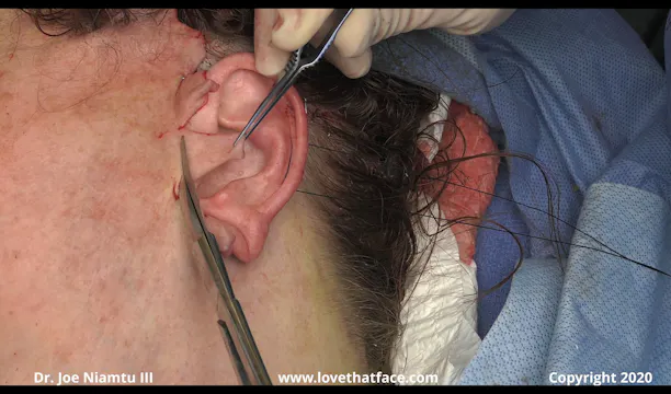 Preauricular Skin Excess Trimming