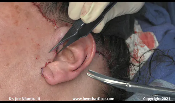 Posterior Tragal Facelift Incision and Reconstruction