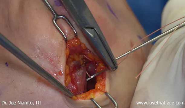 Great Close Up Platysmaplasty Side View Case 1
