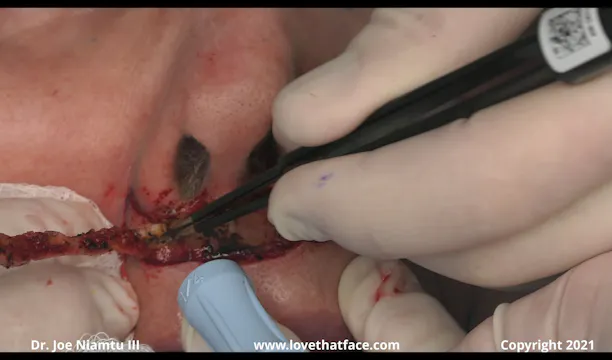 Subnasal Lip Lift Case 2