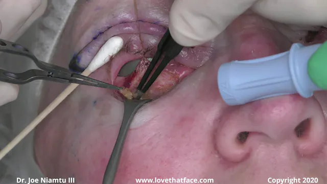 4 Quadrant Blepharoplasty with Canthopexy and CO2 Laser