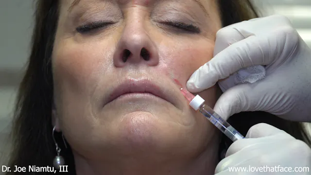 Restylane to Nasolabial Folds with Needle