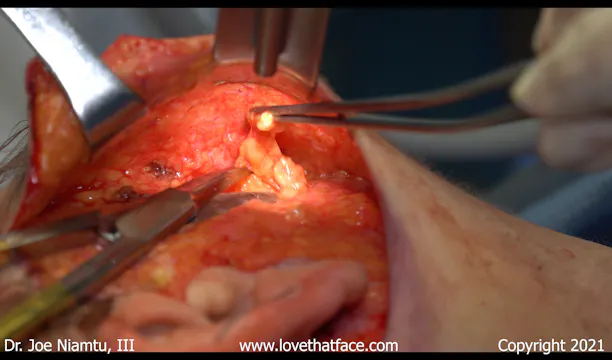 Buccal Fat Reduction Through Facelift Flap