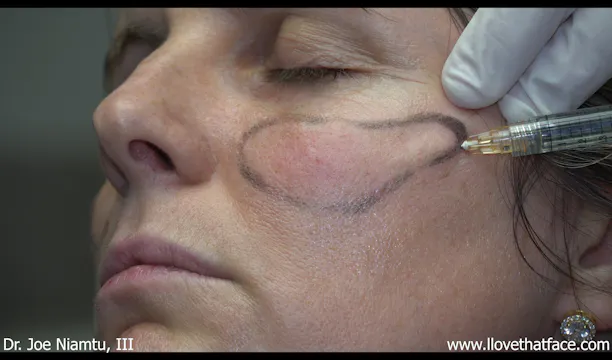 Voluma to Cheeks with Cannula and Needle and Restylane Kysse to Lips