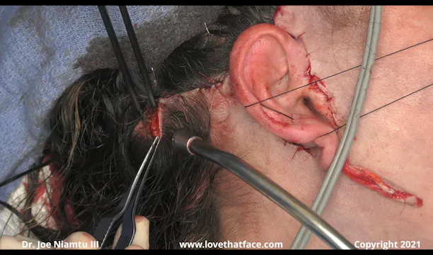 Case 2 Part 3 Unilateral Facelift with CO2 Laser