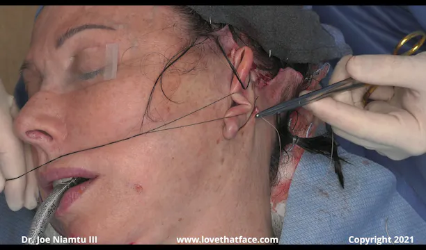 Key Sutures and Skin Flap Trimming
