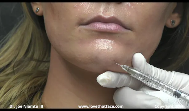 Voluma to Chin, Mentolabial Fold and Mandibular Border
