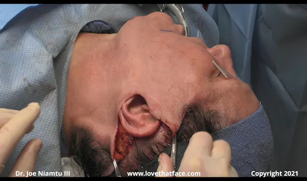 Facelift Skin Tension Vectors Posteriorly and Superiorly